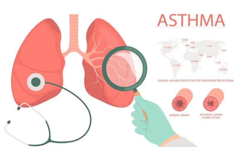 Asthma