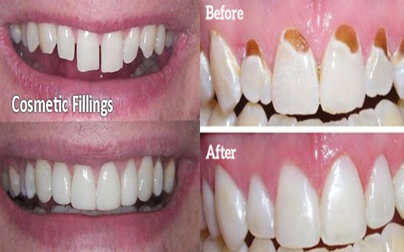 Cosmetic Fillings