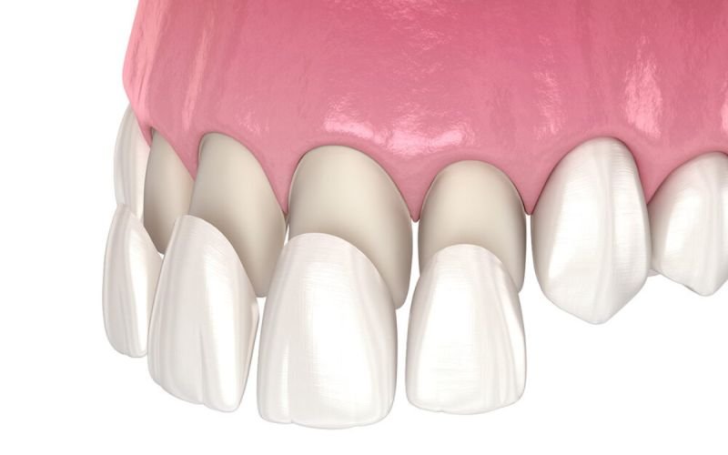 Dental Veneers