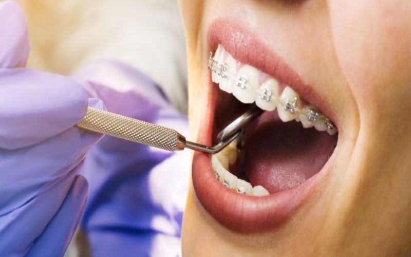 Braces Treatment