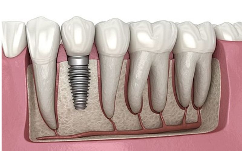 Dental Implant