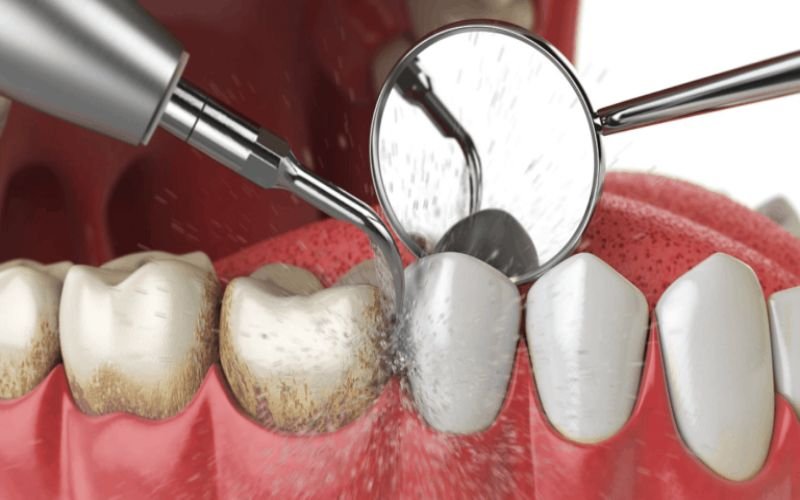 Teeth Cleanings