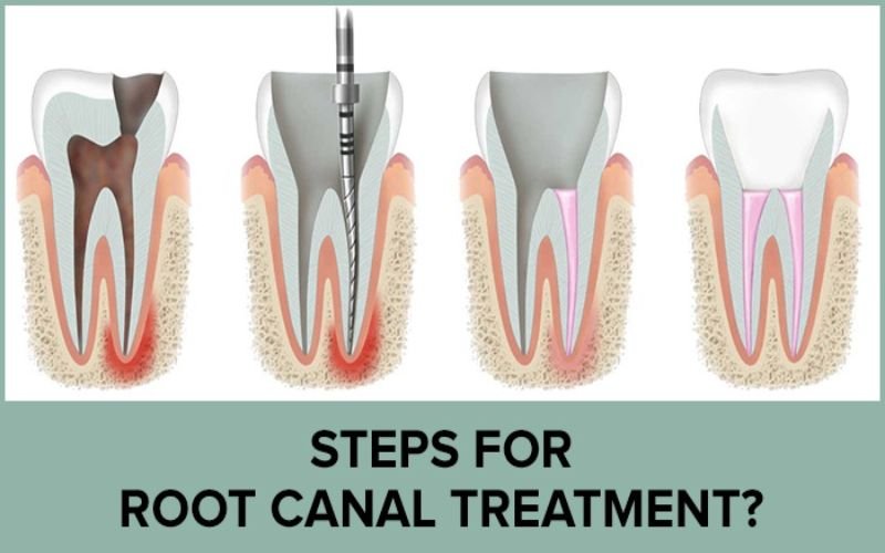 Root Canal Therapy