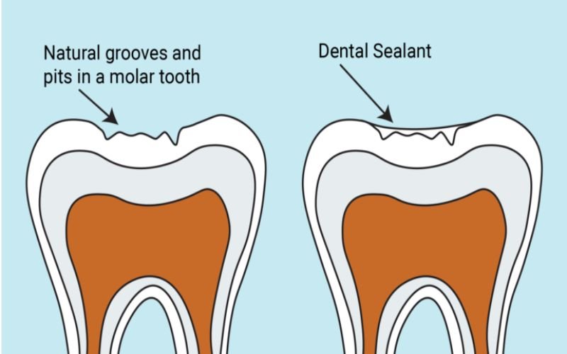 Dental Sealants